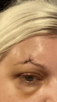 a close up of a woman 's forehead with stitches in it