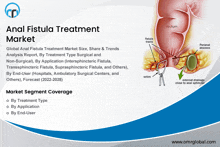 an anal fistula treatment market analysis report