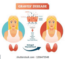 a cartoon illustration of a woman with graves ' disease and an enlarged thyroid gland