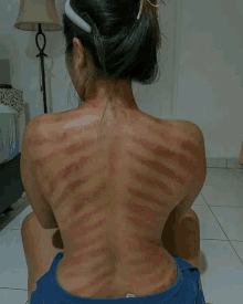 a woman 's back has a lot of red lines on it