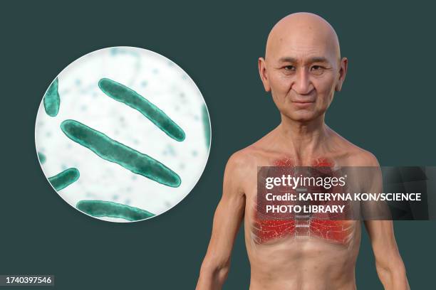 miliary tuberculosis, illustration - human figure green background stock illustrations