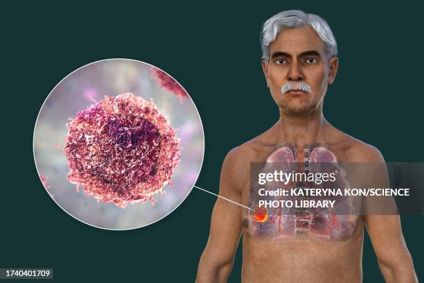 lungs affected by lung cancer, illustration - human figure green background stock illustrations