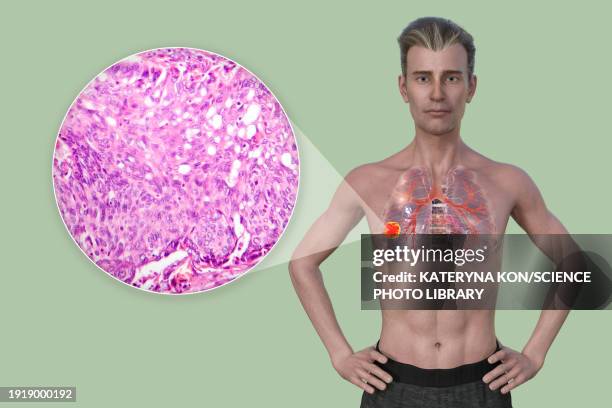 man with lung cancer, illustration - human figure green background stock illustrations