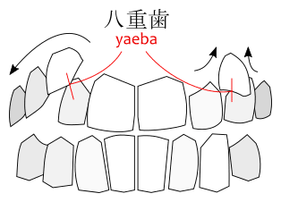 A diagram of yaeba 八重歯, illustrating how canine teeth become misaligned