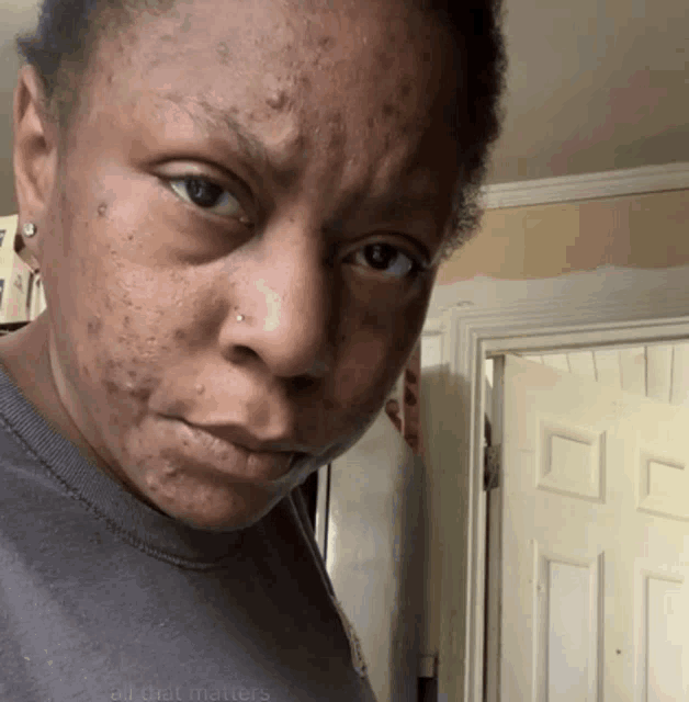 a woman with acne on her face stands in front of a white door