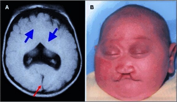 Holoprosencephaly (HPE): What It Is, Causes Types, 58% OFF