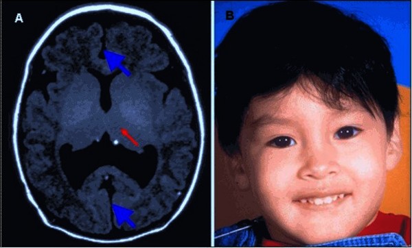 Holoprosencephaly Brain