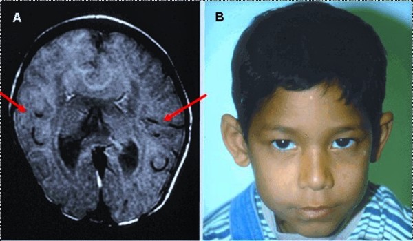 Holoprosencephaly Brain