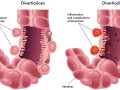 Diverticulosis: When Our Most Common Gut Disorder Hardly Existed