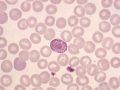 What Does a Low White Blood Cell Count Mean?