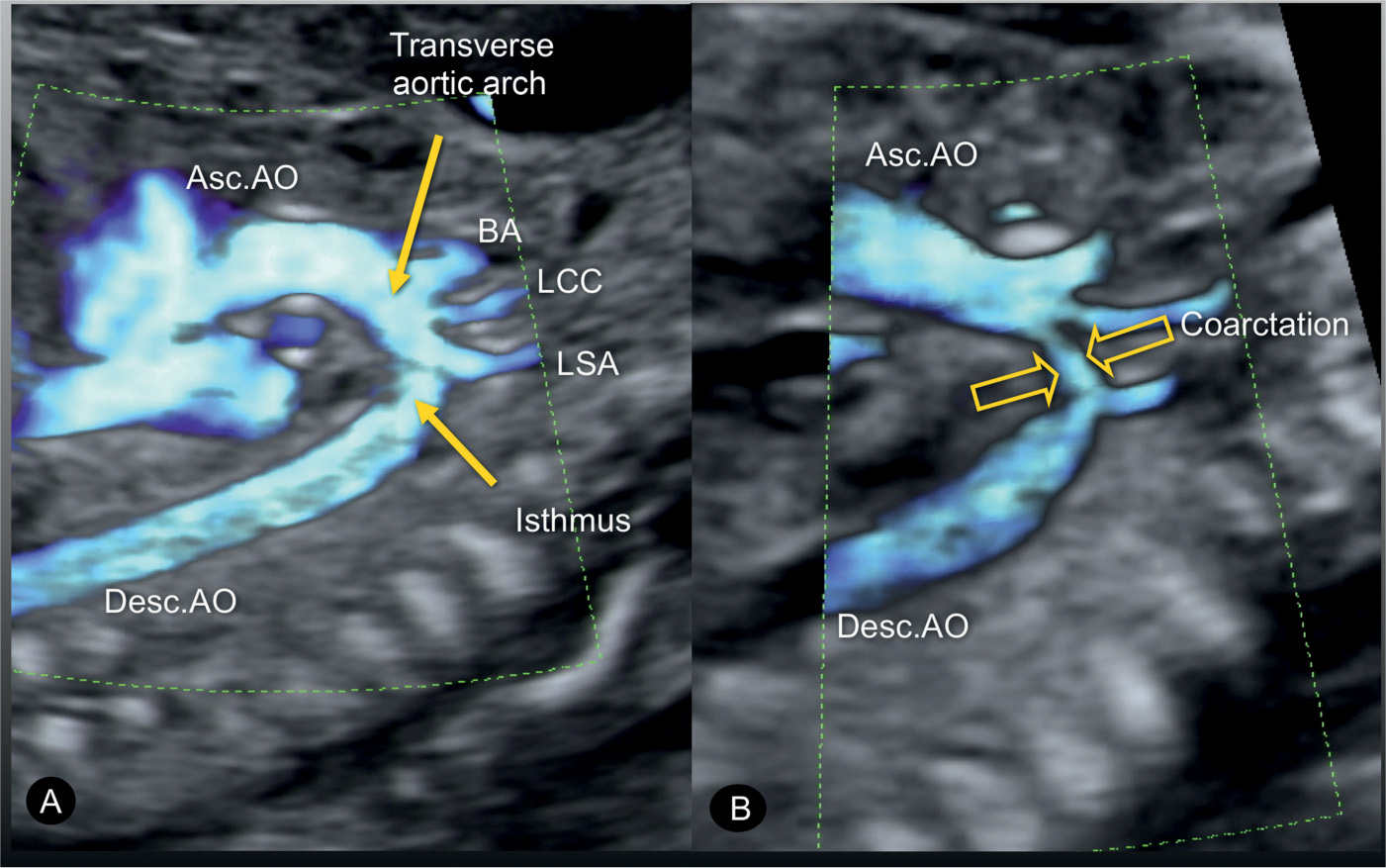 Right Aortic Arch Ultrasound