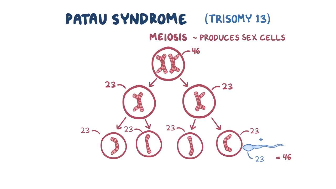 Trisomies Patau Syndrome Edwards Syndrome Down Syndrome | Sexiz Pix