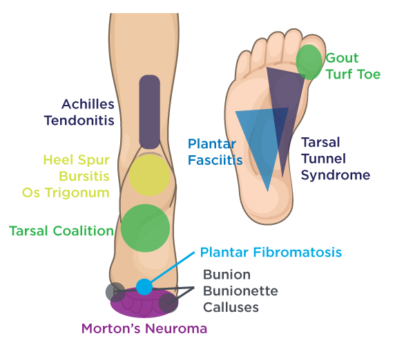 Diagram of Pain Locations on Heel and Bottom of Foot