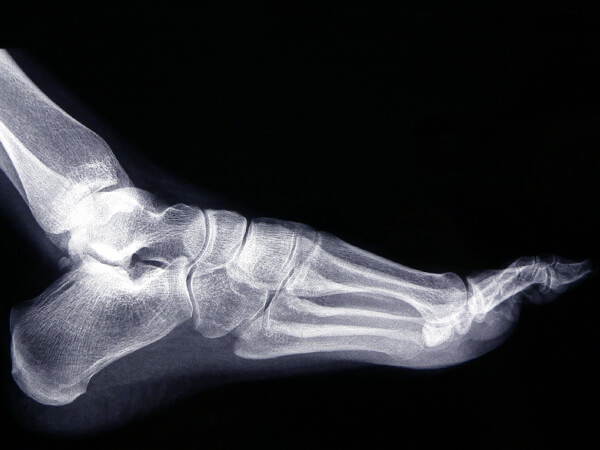 Foot X-Ray