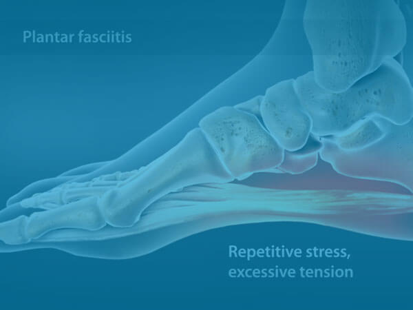 Watch Overview of Plantar Fasciitis