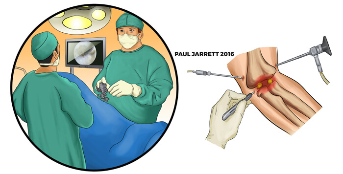 Graphic showing an elbow Arthroscopy