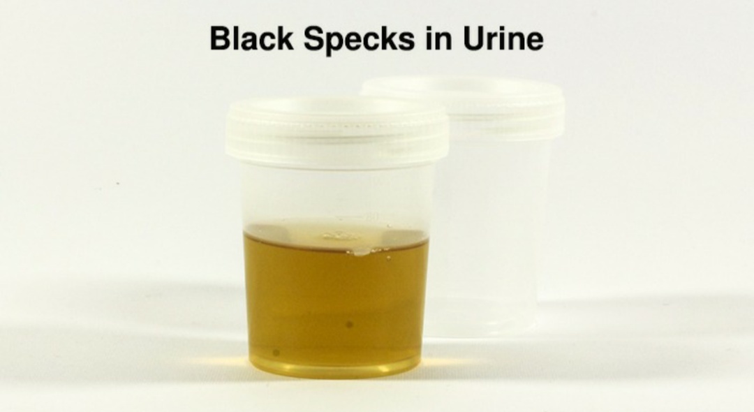 White Stuff In Urine Female | Bruin Blog