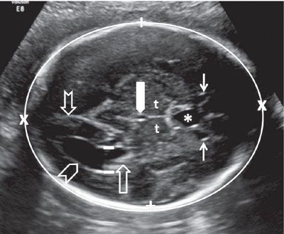 Lateral Ventricles Fetal Brain Ultrasound