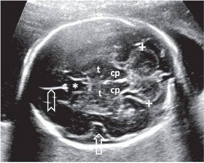 Posterior Fossa Ultrasound