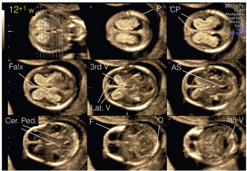 Fetal Skull Abnormalities