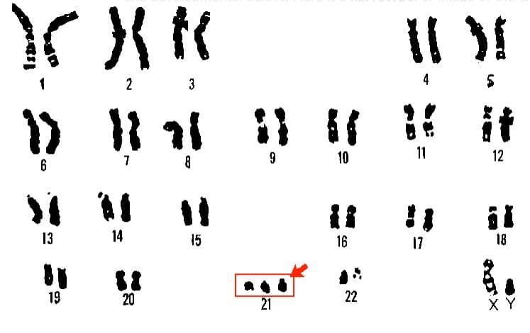 Down syndrome karyotype