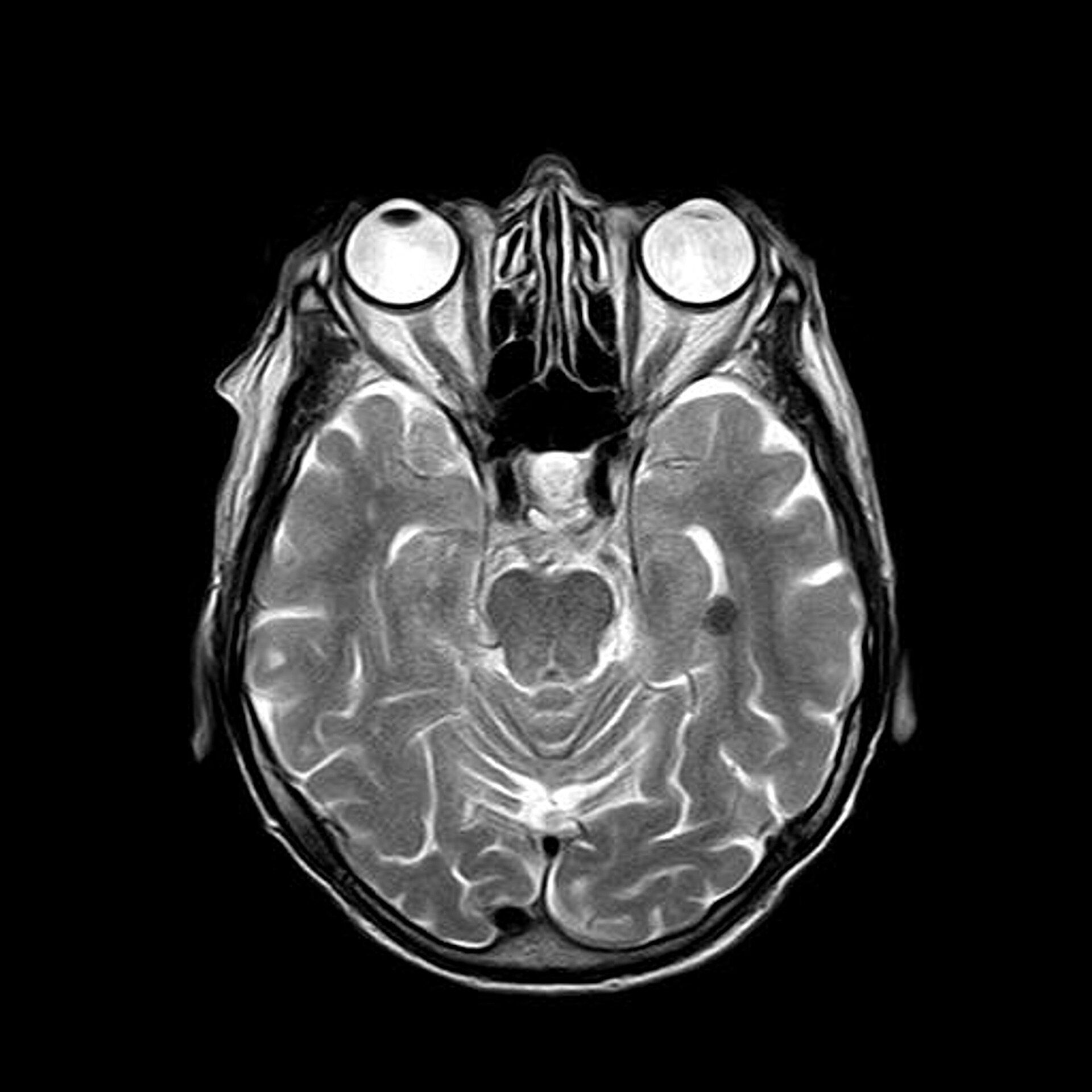 Brain Top View Mri