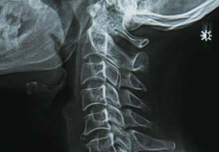 Degenerative Disc In Thoracic Spine