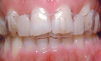 clear aligners