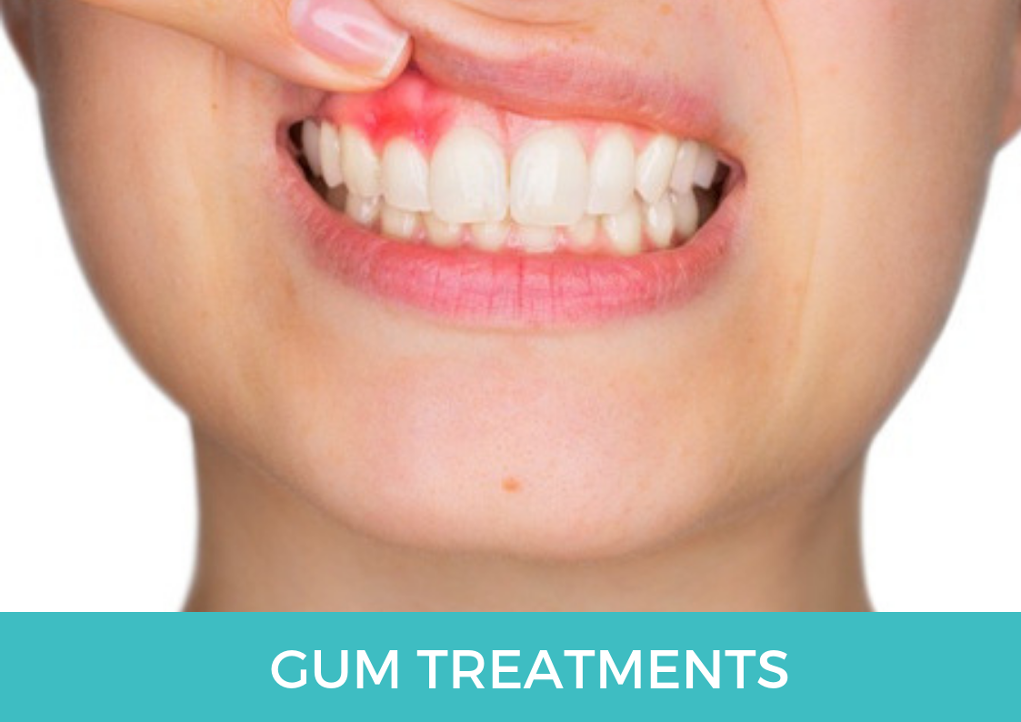 Gum Treatments In vijayawada