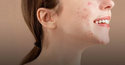 6 Vitamins and Minerals That Girls Should Eat, Guaranteed to Really Reduce Acne