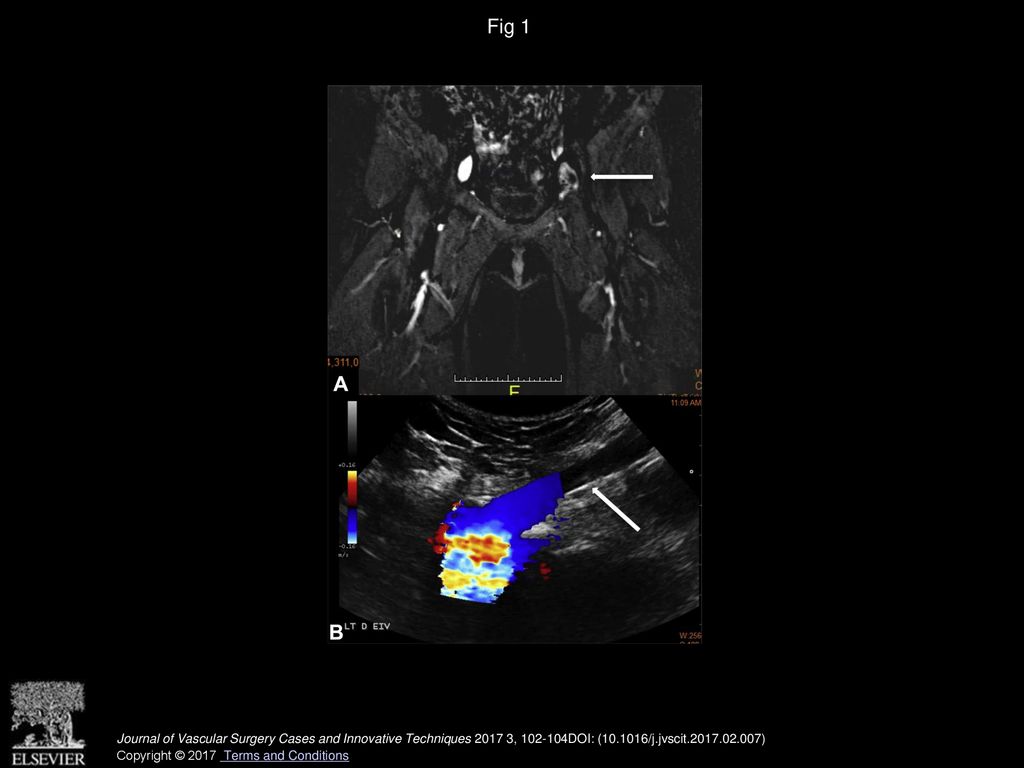 Inguinal pain and fullness due to an intravascular leiomyoma in the ...