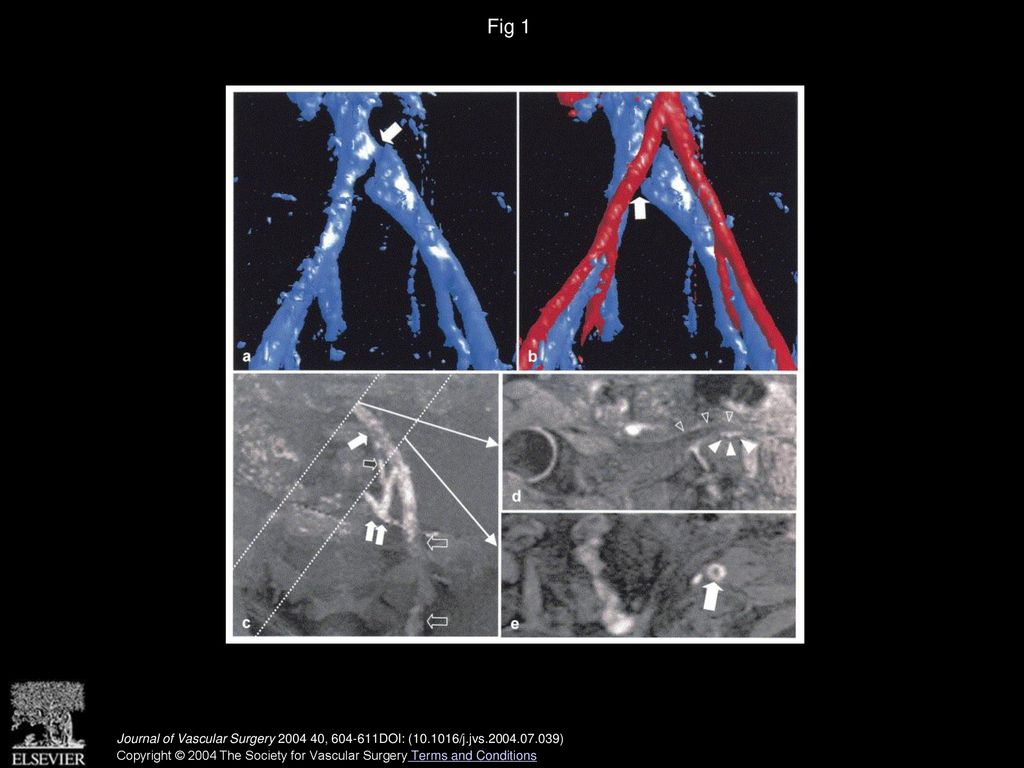 Re-evaluation of iliac compression syndrome using magnetic resonance ...