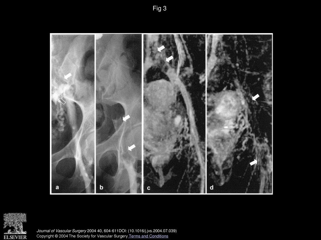 Re-evaluation of iliac compression syndrome using magnetic resonance ...