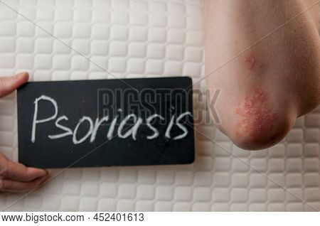 Acute Psoriasis On Image & Photo (Free Trial) | Bigstock